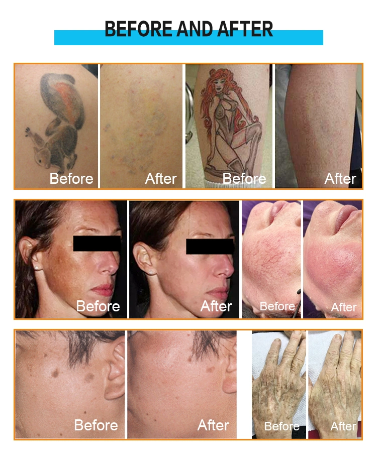 Cost Effective Environmental Protection G5 Massage Tattoo Age Spot Removal Laser Machine