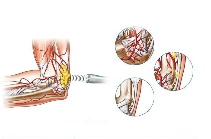 Portable Shockwave Therapy for Ede Swt Storz Shockwave Therapy Pain Relief Tendonitis Shoulder Joints Machine