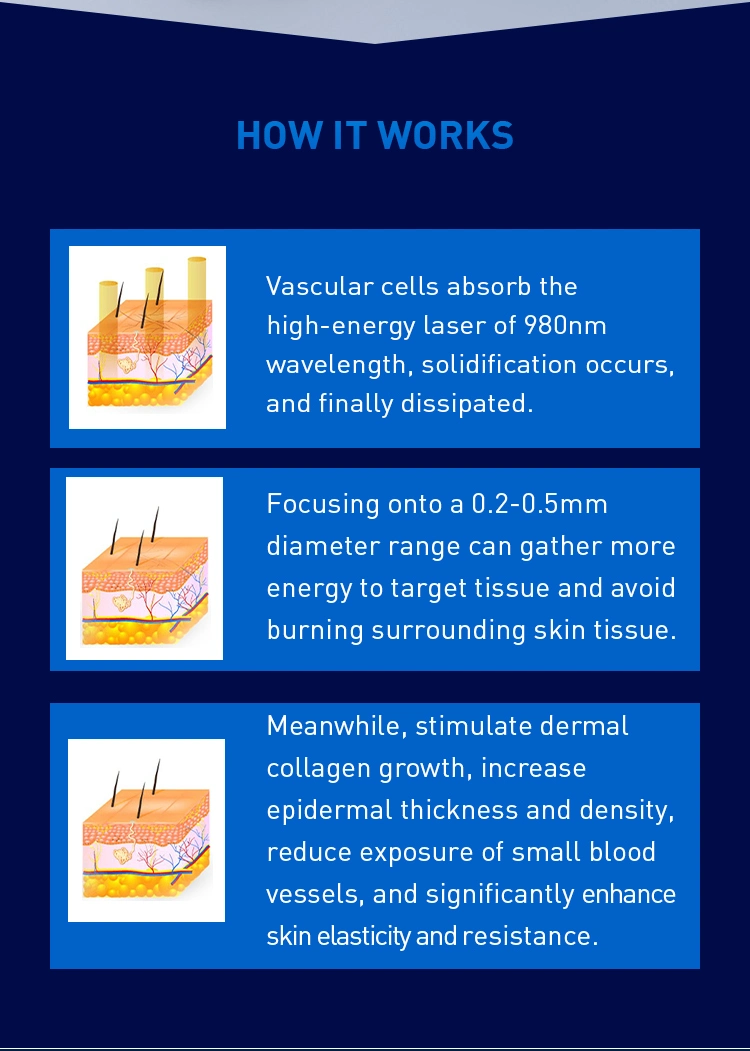 980nm Pain Relief/Laser Treatment / Vascular Removal Machine