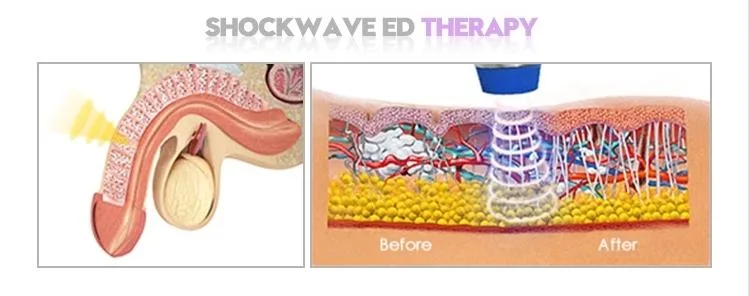 Shockwave Erectile Dysfunction Retatment Equipment for ED Shock Wave Therapy Device