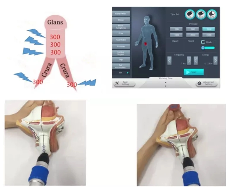 Focused Extracorporeal Shockwave Therapy System Radial Shockwave Therapy Machine Eswt