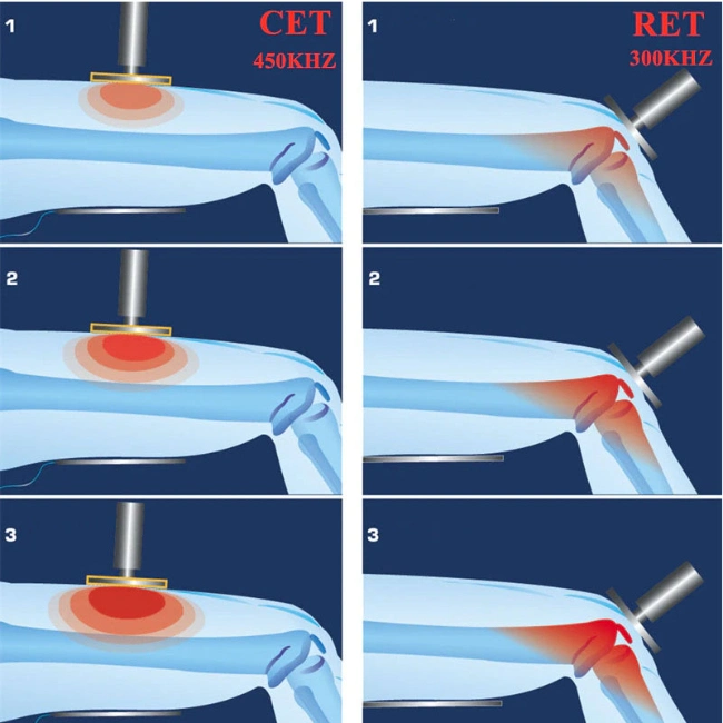 3 in 1 Smart Tecar Wave RF EMS ED Shockwave Therapy Tecar Physiotherapy Machines for Pain Relief