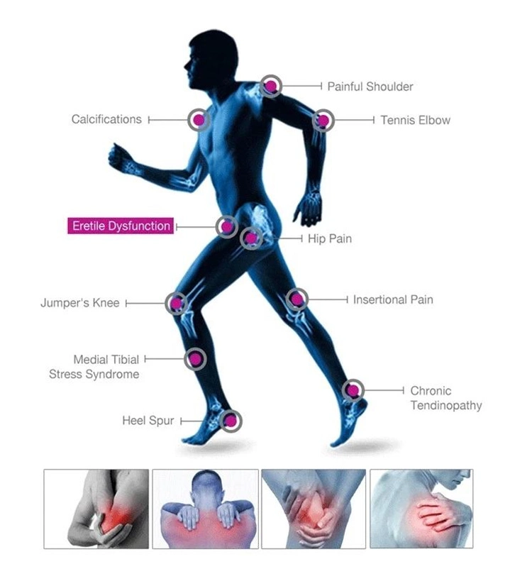 Shockwave Therapy Machine for Pain Relief Sport Injury ED Treatment