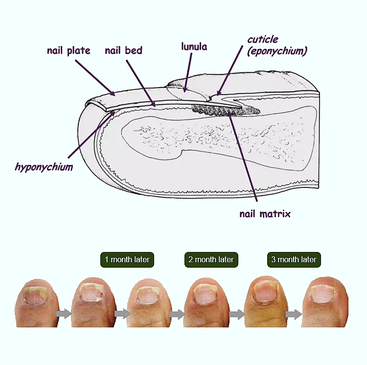 Onychomycosis Antifungal Low Level Laser Therapy Device