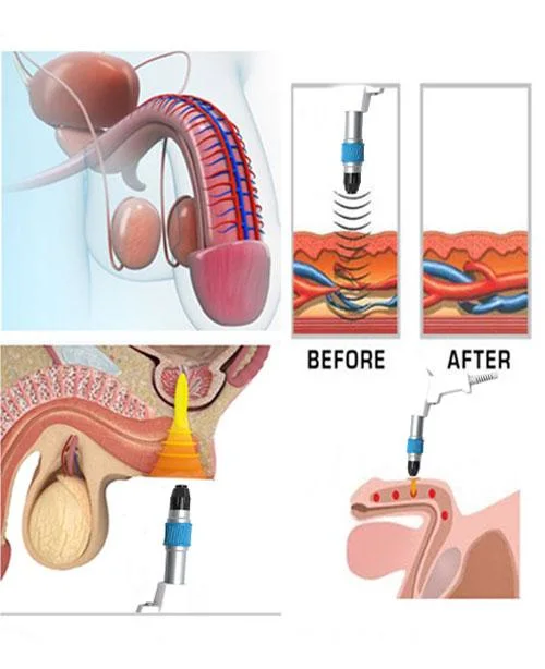 Pneumatics Penis Massage Therapy Shock Wave Penile Enlargement Device / Vertical Shockwave Machine for ED Erectile Dysfunction