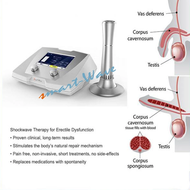 Edswt Male Healthcare Use Shockwave Machine for Erectile Dysfunction