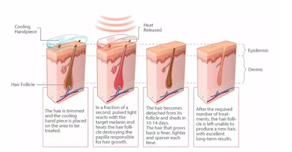 Best Professional Laser Hair Removal Treatment Depilation Machine 2024 in Clinics