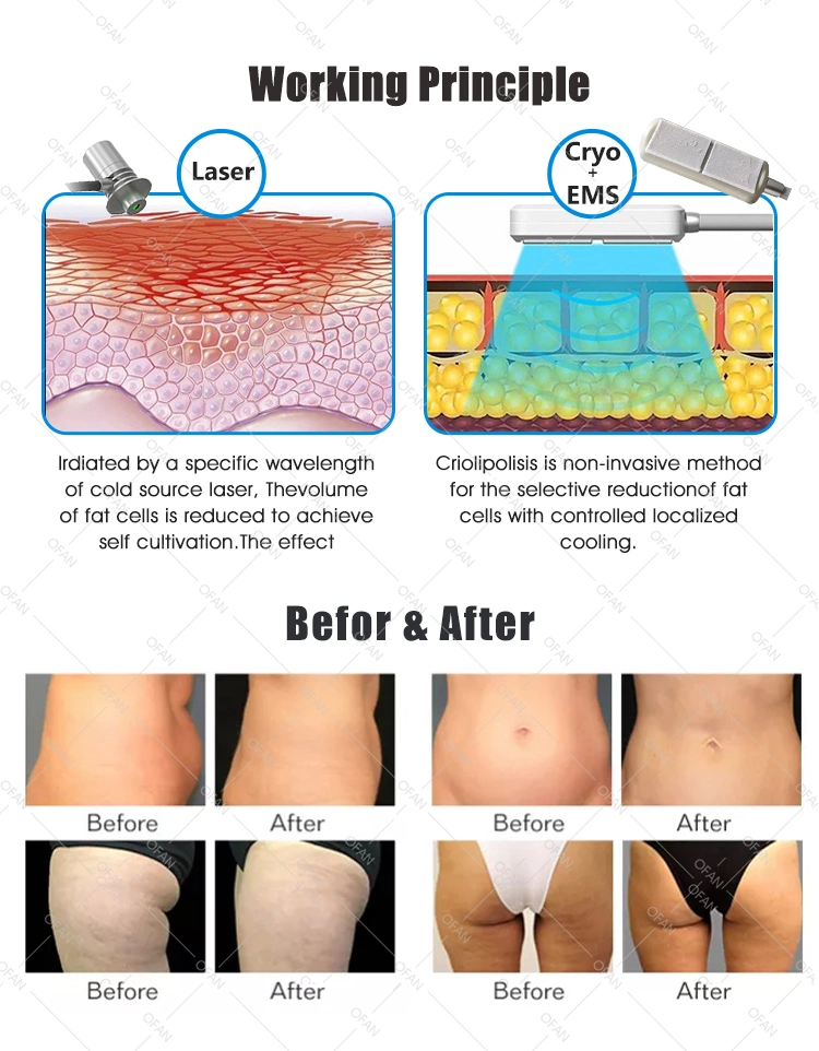 Machine Estetica Aparatologia Corporal Cliolipolisis Cool Sculpting Machines Laser Slim 360 Fat Freezing