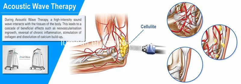 Extracorporeal Shock Wave Therapy Equipment Acoustic Shock Wave Therapy Machine