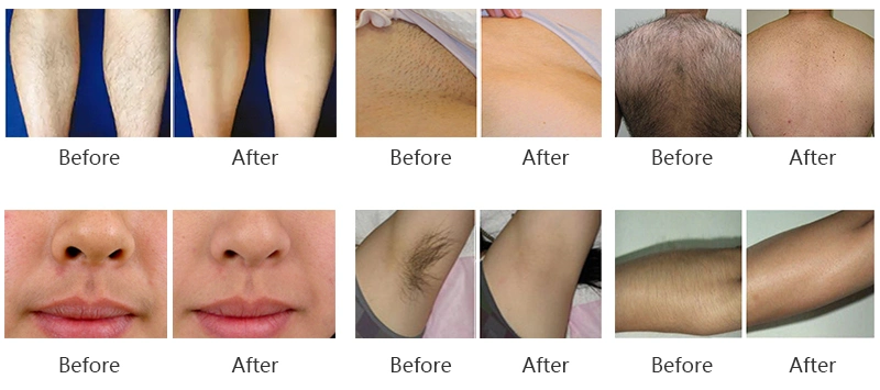 Pain-Free Hair Removal Treatment Triple Wavelength Hair Removal