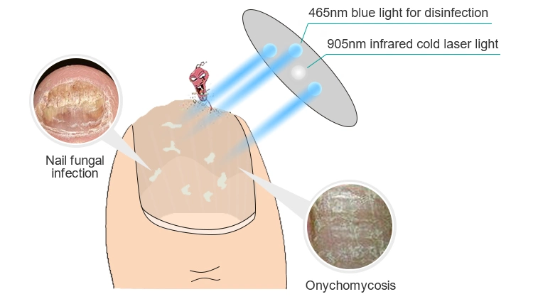 Superior Quality Nail Fungus Infection Low Level Laser Therapy Device