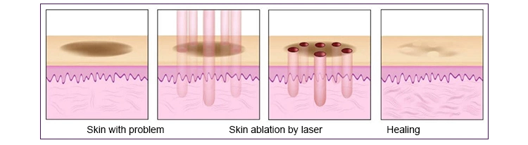 Newest 10600nm Super Pulsed CO2 Cold Fractional Laser Equipment Skin Beauty Equipment with 30W Output Power