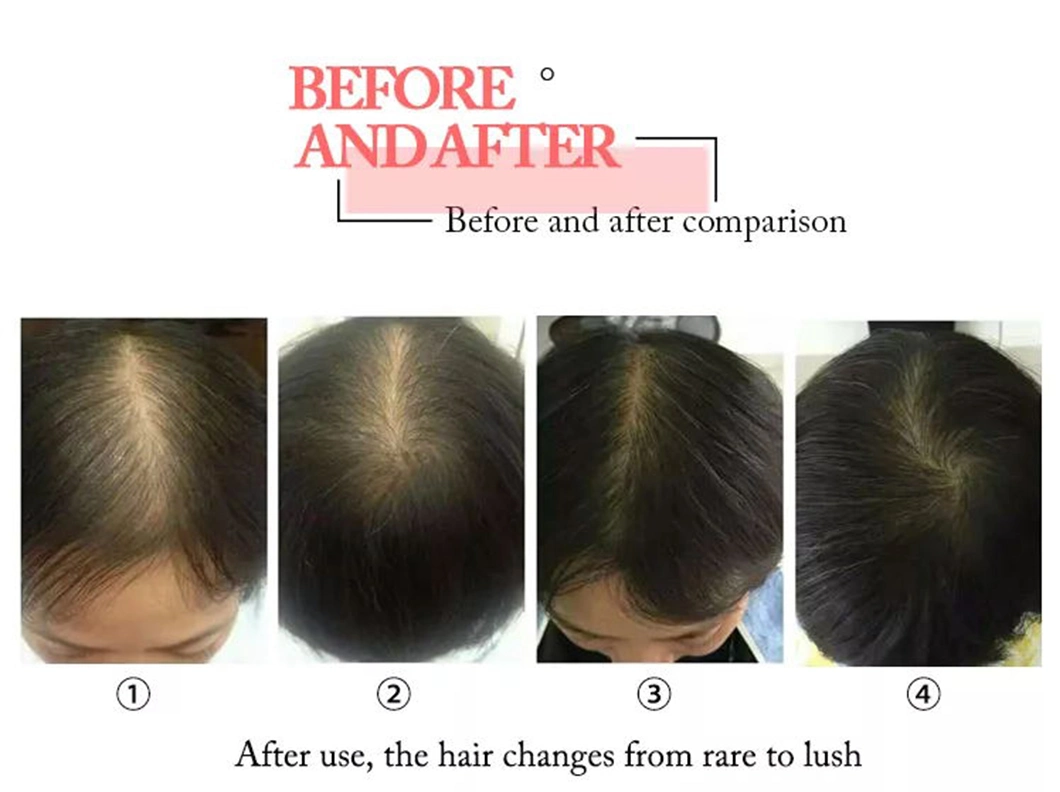 High Quality Anti Hair Loss Low Level Laser Light Therapy for Hair Growth