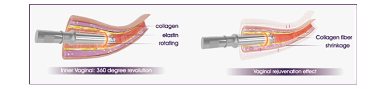 Vaginal Rejuvenation RF CO2 Fractional Laser for Acne Scars