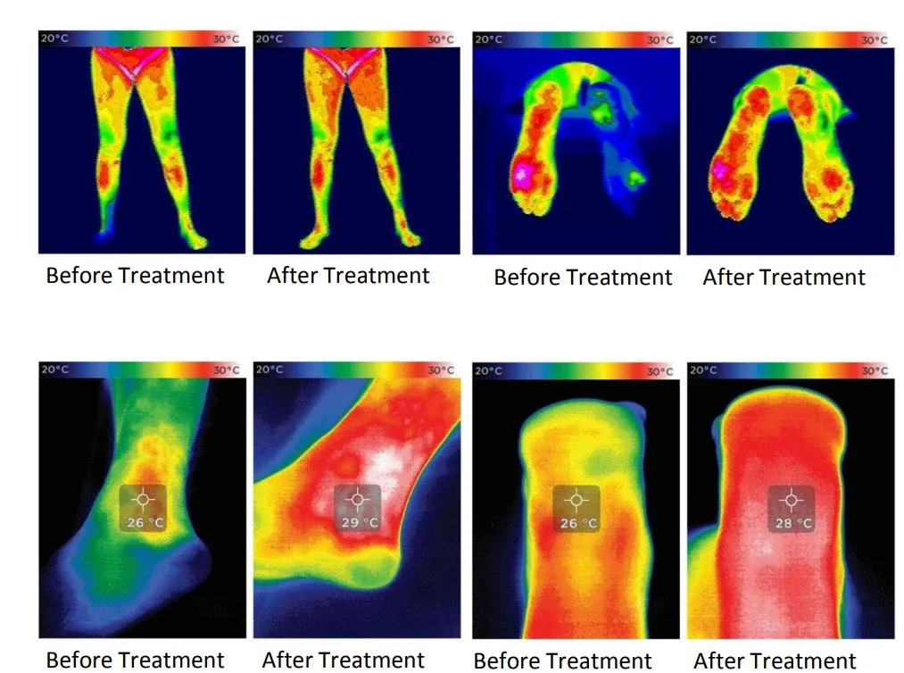 Electromagnetic Wave Pulse Muscle Pain Treatment Magneto Physical Therapy Magnetotherapy Device