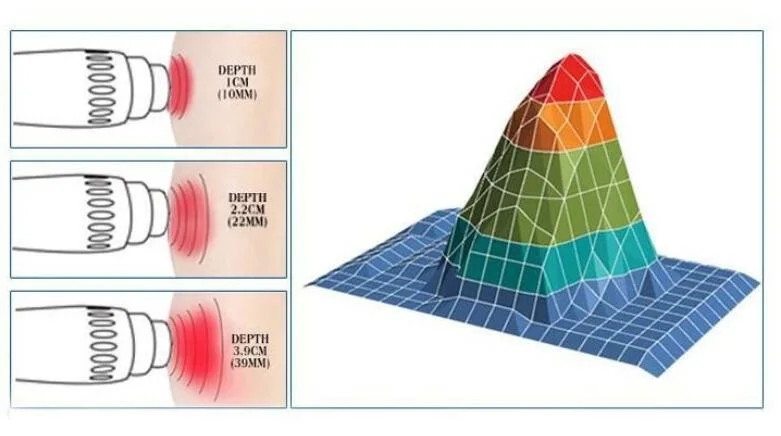 Shock Wave Device Focused ED Treatment Machine Pneumatic Erectile Dysfunction Physical Pain Relief Focused Shockwave Laser