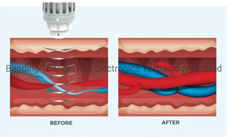 Pain Relieving Mobility Restoration Acceleration of Healing Shockwave Eswt Machine