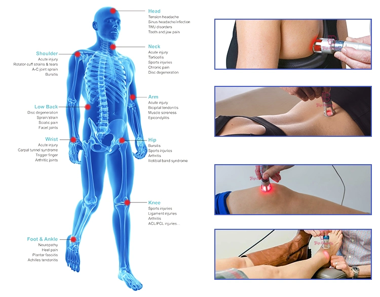 980nm Lumbar Back Pain Relief Low Level Laser Therapy Cold Laser Therapy Physiotherapy Device