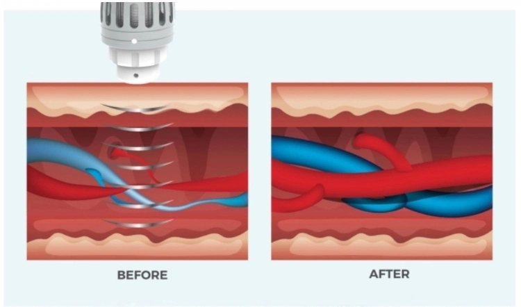 Erectile Dysfunction Shockwave Treatment Device