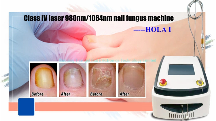 980nm Diode Laser Machine Nail Fungus Removal