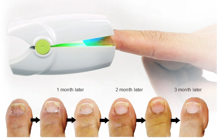 Superior Quality Nail Fungus Infection Low Level Laser Therapy Device