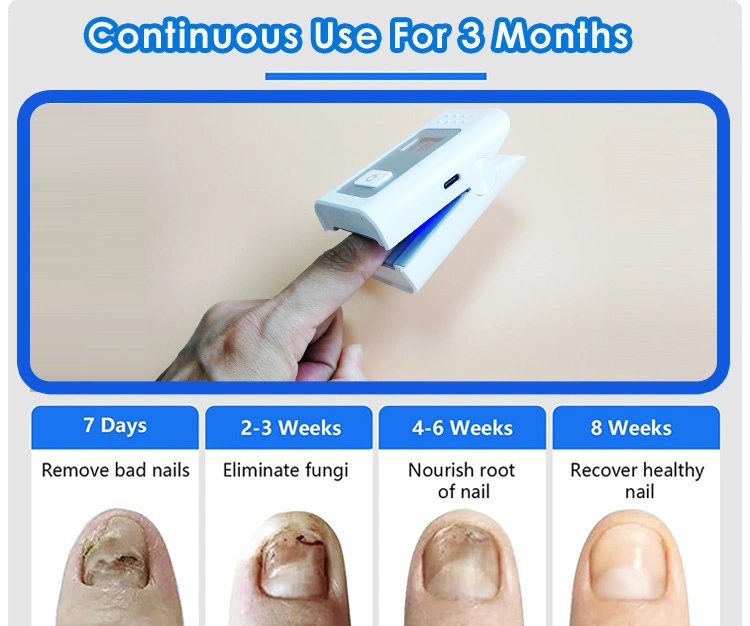 Mini Homecare Treatment Device Recharageable Toe and Finger Nail Fungus Laser