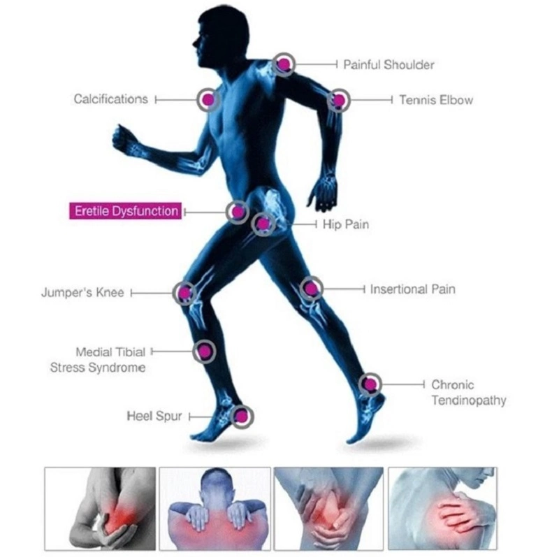 Shockwave Therapy Equipment Machine for Leg Knee Pain Relief ED Treatment