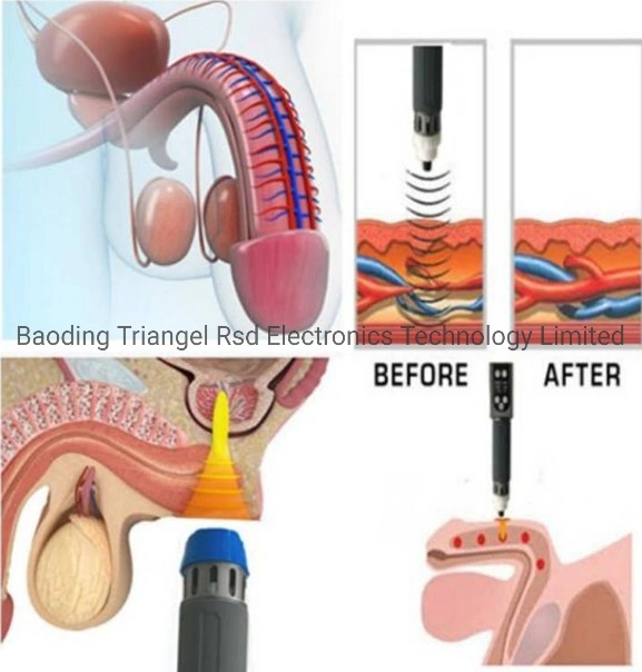 Pain Relieving Mobility Restoration Acceleration of Healing Shockwave Eswt Machine