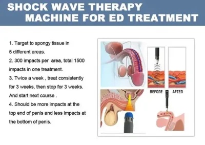 Fisioterapia instrumento tratamiento del dolor Terapia de onda de choque físico / onda de choque Máquina para ED