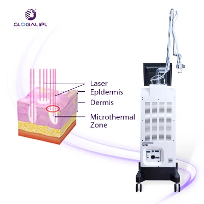 Láser de CO2 fraccional de RF de equipamiento para la extracción del pigmento láser de CO2 fraccional de Rejuvenecimiento Vaginal