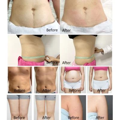 Lipo láser 6D Adelgazar EMS Crio la conformación de 635nm láser frío la quema de grasa de eliminación de celulitis Lipo Laser