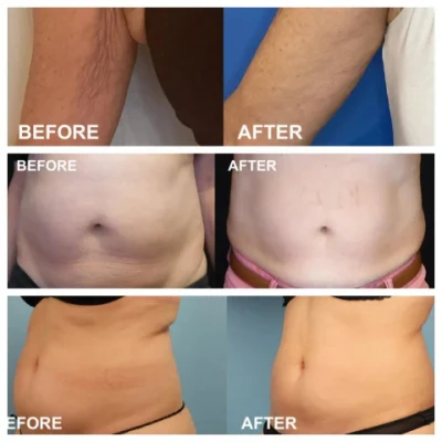 Dispositivo de Terapia láser de Lipiólisis fría 635nm placa de reducción de grasa Cryo
