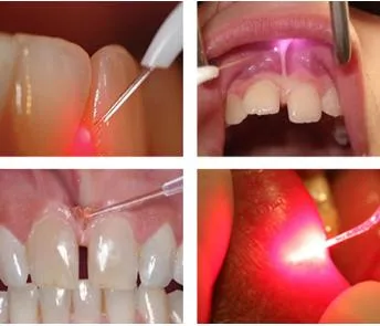Gran oferta, corte de tejido blando de bajo nivel, tratamiento de odontología, máquina láser Dental médica 980nm