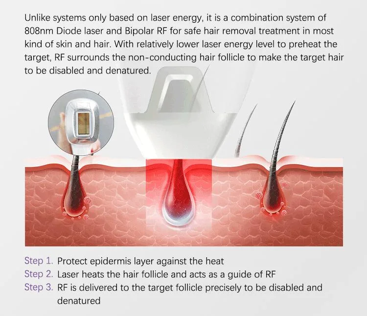 Star Selling Laser Diode 755+808+1064 Diode Laser Hair Removal Machine Laser Diode Treatment with Medical CE