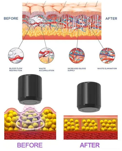 Professional Doris Aesthetics ED Shock Wave Therapy Machine Focused Shockwave Machine Physical Therapy Pain Relief Shockwave Equipment