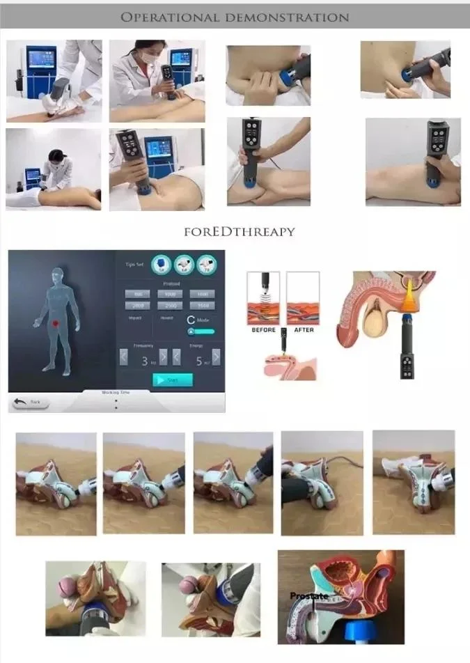 Double Extracorporeal Erectile Dysfunction Penis Focus ED Shockwave Wave Therapy Machine Price