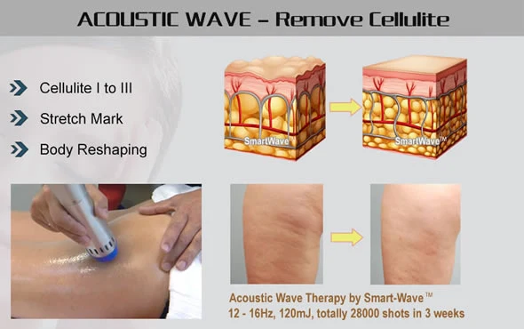 Professional Medical Sound Physiotherapy Wave Equipment