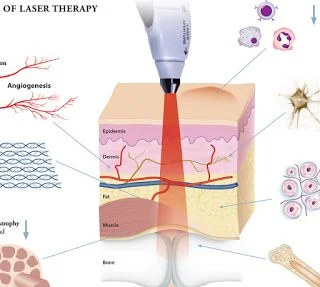 Top Sale Cold Laser Therapy 980nm Muscle Pain Relief Treatment Medical Facial Treatment Machine