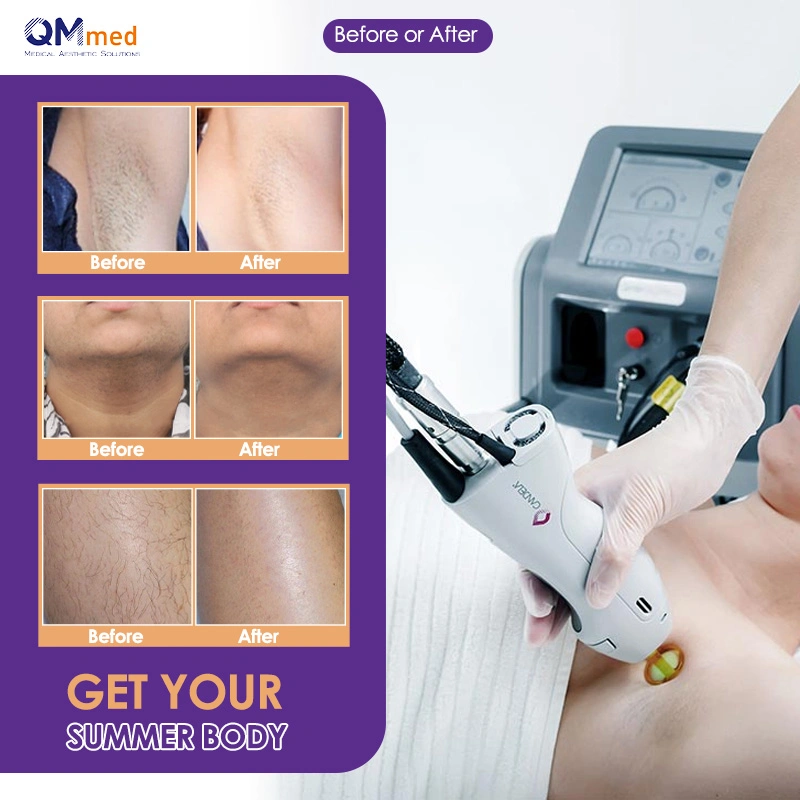 Qm Hot Sale Professional Alexandrite Laser Hair Removal 755nm 1064nm Alexandrite Laser for Salon SPA with Skin Cooling Device Alexandrite Hair Removal Laser