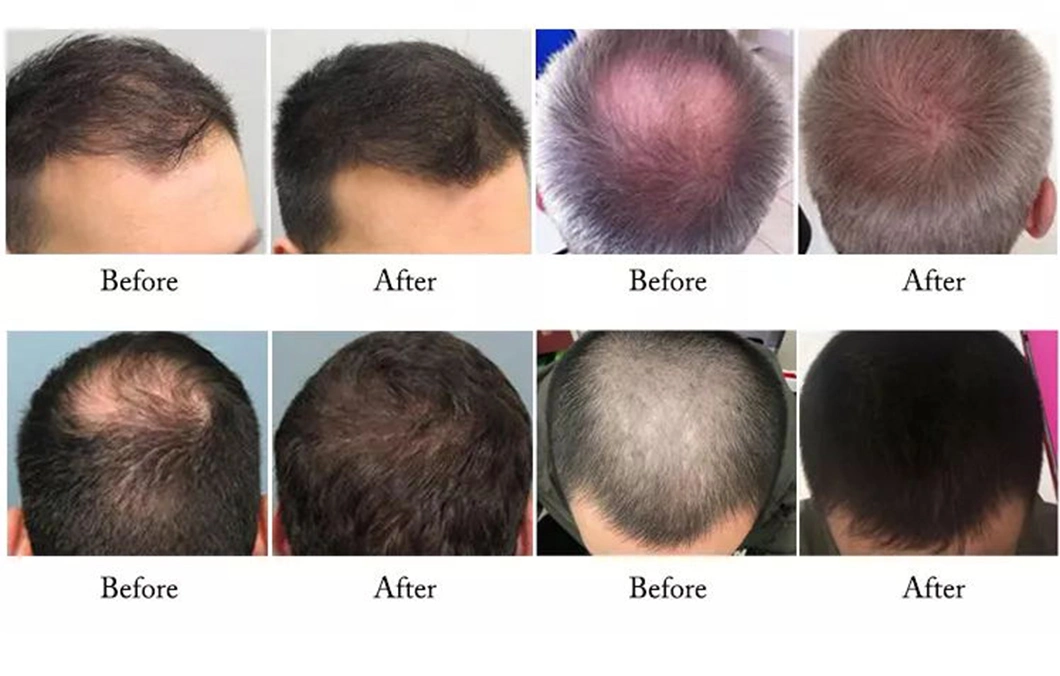 Regrowth Anti Hair Loss Alopecia Areata Low Level Laser Light Therapy for Hair Growth