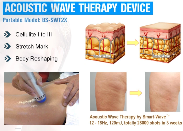 Radial Acoustic Wave Therapy Machine for Cellulite Treatment