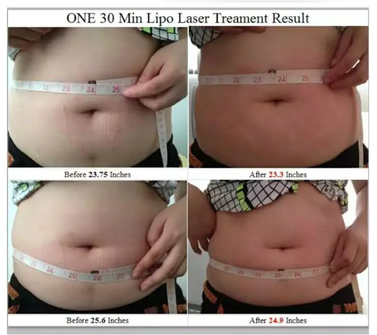 Effective Fat Removal Light Lipo Laser Slimming 5D 650nm +780nm&808nm+940nm&980nm Cold Laser Therapy