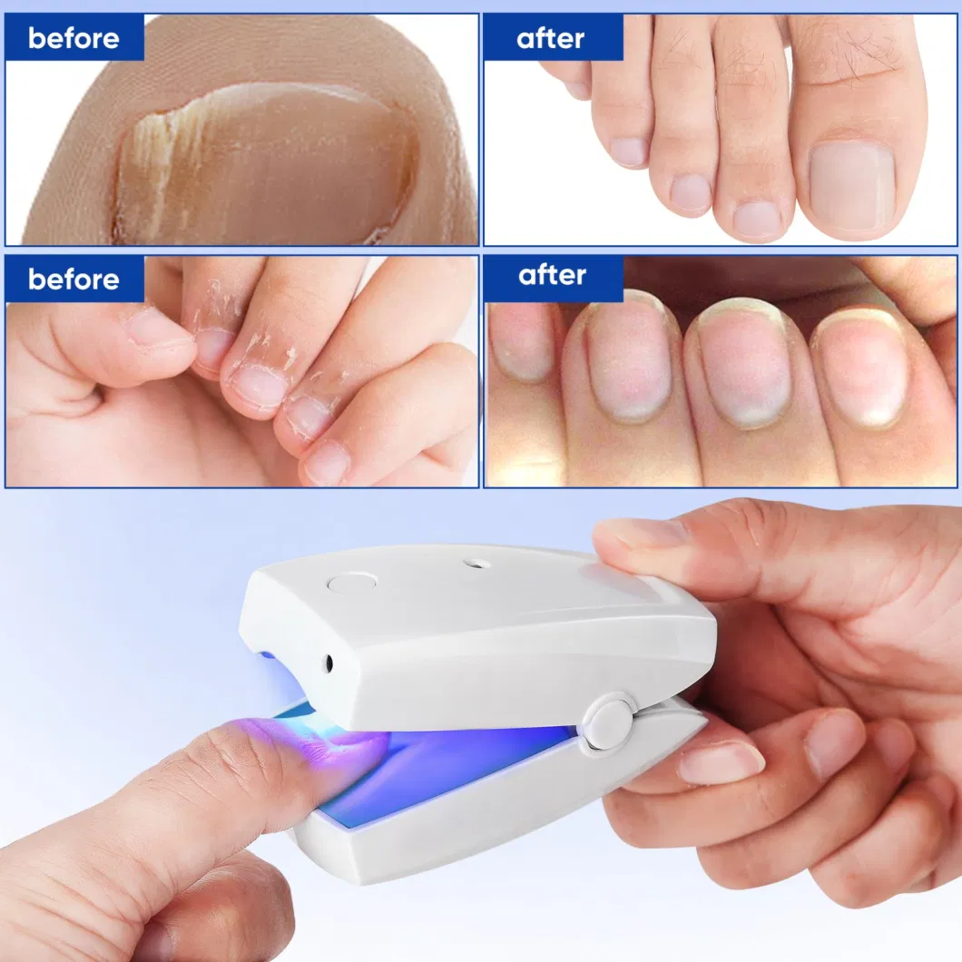 Cold Laser Therapy Device for Fungal Infections of Fingernails and Toes