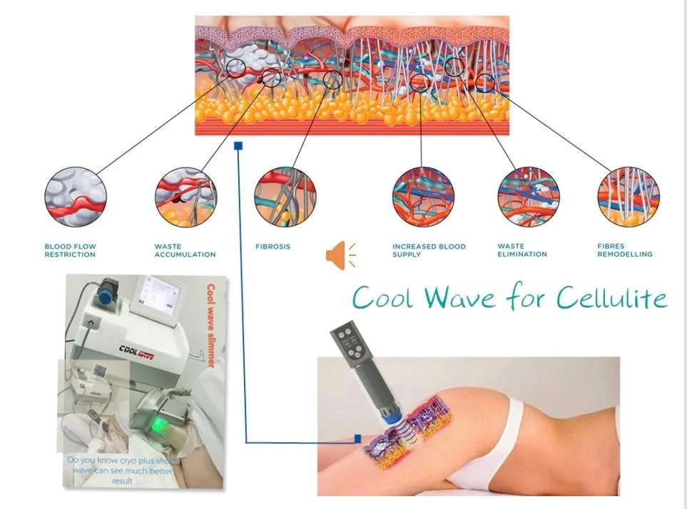 Cool Wave Therapy Combination of Shockwave and Cryo Fat Freezing Device Slimming Machine