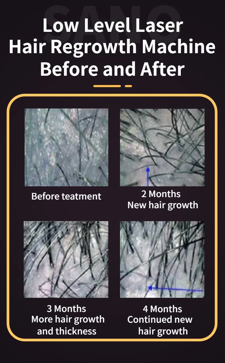 650nm Low Level Laser Hair Restoration Hair Regrowth Laser