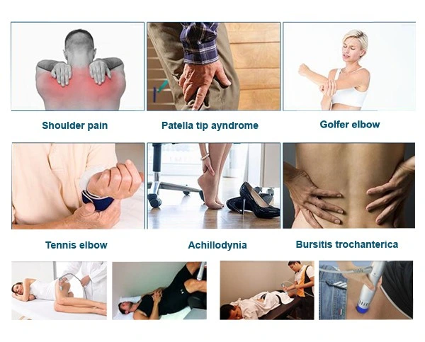 Physiotherapy Machine Shockwave Therapy for Heel Spur