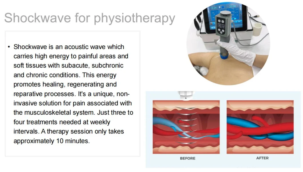 Ultrashock Therapeutic 21 Hz Ultrasound Shockwave Physiotherapy Machine