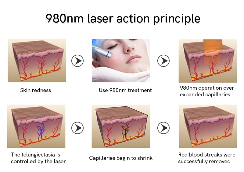 Portable 980nm Diode Laser Vascular Therapy Machine