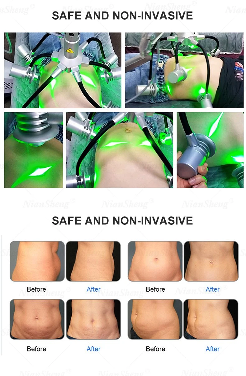 Niansheng Cold Lipo Laser Fat Loss Lipo Laser 532nm Weight Loss Fat Reduction Laser 6D Green Light Laser