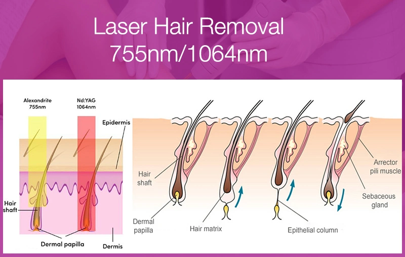 Alexandrite Laser Hair Removal 755nm 1064nm Alexandrite Laser for Salon SPA with Skin Cooling Device